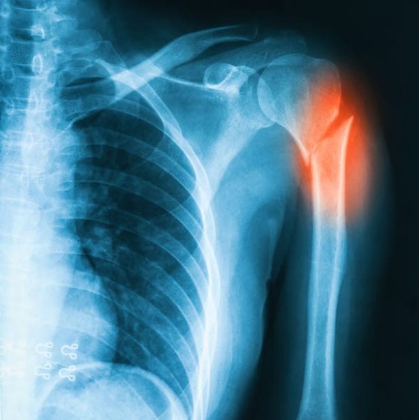 Vitamin-D bei Osteoporose