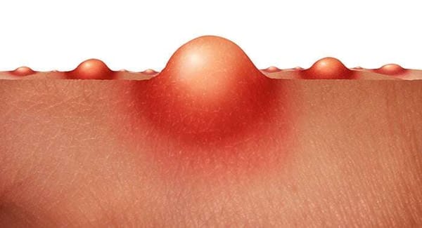 Vitamin D gegen Akne