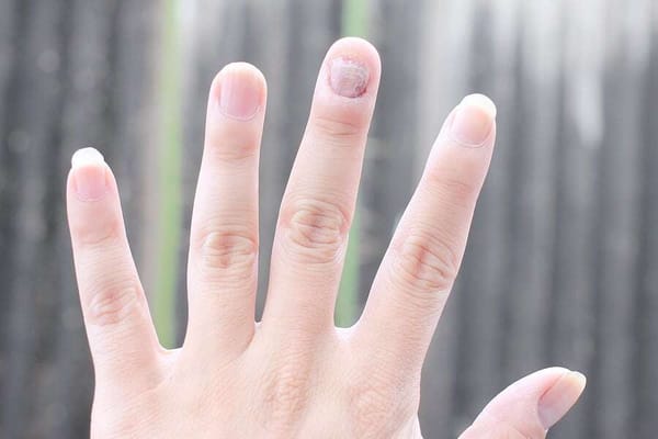 Vitamin D und Nagelpilz
