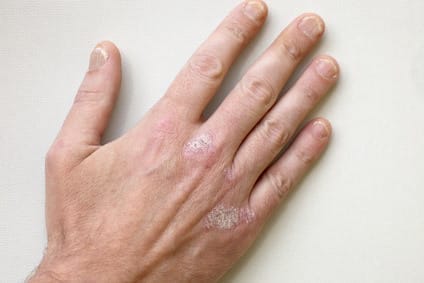 Einfluß Vitamin D auf Atopisches Ekzem